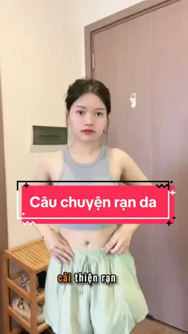 Cách mình xử lý rạn da tại nhà #rạnda #kemranda #ovelaabera #fyp #trending #xuhuong #tips #lamdep 