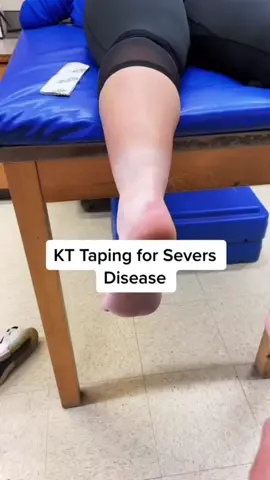 #seversdisease #putthatinanicebath #onthisday  