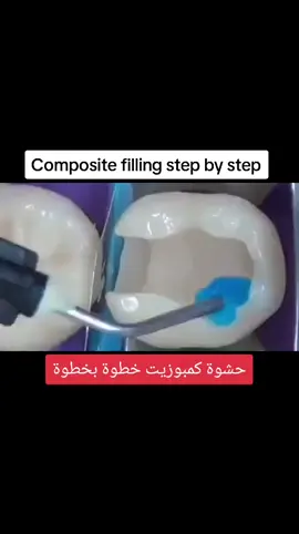 حشوة ضوئية  Composite filling  #سامرعقاد #SamerAkkad #teeth #dental #dentist #dentista #dentistry #prosthetics #braces #cosmeticdentistry   #crown  #instadentist #dental #dentist #medical #Teeth #smile  #dentista #odonto #health #dentalstudents  #dentalpost  #oralsurgery #endodontia #endodontics #odontogram#stomatolog #tooth #الأسنان #الاسنان #أسنان #اسنان #طبيب_اسنان #دكتور_اسنان #عيادة_تجميل #عيادة_اسنان #سن #طب_اسنان 