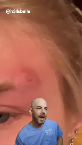 This one looked like it hurt!!  - #squeezeyuk #acne #pimple #pimplepop #blackhead #satisfying #foryoupage #foryou  #تنظيف_بشره  #whiteheads #رؤوس_سوداء #عنايه_بالبشره #دهون 
