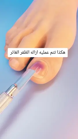 هكذا تتم عمليه ازاله الظفر الغائر#طب #طبخ #الامارات #مشاهير_تيك_توك #السعودية #مصر #متابعه #مالي_خلق_احط_هاشتاقات  #الشعب_الصيني_ماله_حل😂😂 #بلال_الحداد #رياكت #طب_بشري  #ریاکت #السعودية🇸🇦 #معلومات_طبية 