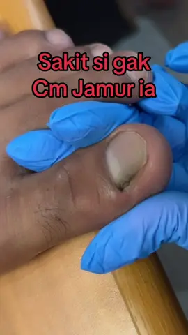 Jamur nail fungus. Pasien hrs tetes obat jamur selama sbulan ya utk menghilangkan  jamurnya lbh melebar