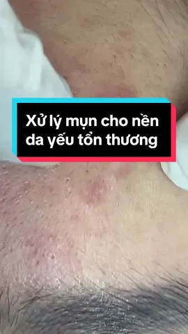 Nên da yếu tổn thương được xử lý nhẹ nhàng hết sức!#cleohouse #trimun #munviem #munan #nặn_mụn #nghiennanmun 