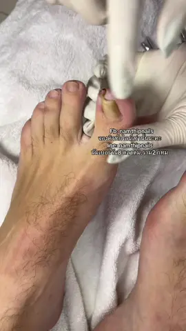 💓 #namthipnails #ตัดเล็บขบ #ตัดหนัง #ทำเล็บ #ร้านตัดเล็บขบ #ร้านตัดเล็บขบราม2 #ร้านทําเล็บ #เล็บขบ  #เล็บเชื้อรา Fb : namthipnails  Line : @namthipnails  นัมเบอร์วัน8 ตลาดม.ราม2  กทม  Map: namthipnails  https://goo.gl/maps/JmwpCKLfKwmhKGK96  ร้านเปิดทุกวัน เวลา12.00น-22.00น.