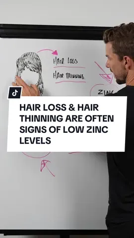 If you notice your hair starting to thin out … or perhaps even early stages of hair loss … it could be worth checking how much Zinc you’re getting in your diet.  Zinc supports a protein in our hair called Keratin.  And keratin supports hair strength, hair length & the overall health & integrity of your hair.  When we’re low in zinc, we’re not able to produce as much keratin.  Leading to symptoms like hair loss & hair thinning.  #hairloss #hairthinning #hair #zinc #zincbenefits 