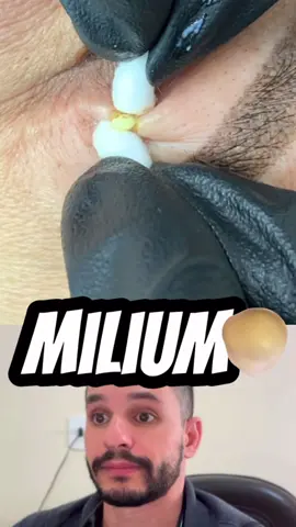 Milium são pequenos cistos ou pápulas de queratina amareladas ou esbranquiçadas na pele. Geralmente na região da face, no entorno dos olhos, bochechas, nariz, atrás da orelha, além de poder aparecer nas mãos, costas e no pescoço. A condição também é conhecida como milium sebáceo ou mília.  As causas do milium não são totalmente conhecidas, no entanto acredita-se que aparece devido à uma degeneração das fibras elásticas da pele e das células que produzem a queratina, Essa degeneração é provocada pela exposição excessiva aos raios ultravioletas do sol.  O principal sintoma do milium é o aparecimento das bolinhas, que podem: coçar ou não, são parecidas com um cisto. O milium tem cura e o tratamento é recomendado por dermatologista. Entre as formas de tratamento incluem-se a limpeza de pele e o uso de alguns medicamentos. #milium #skincare #pele