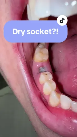 Sorry it’s grim but I think it’s coming back 😒🤕😢😮 #drysocket #toothextraction #tooth #dental #toothout #toothinfection 