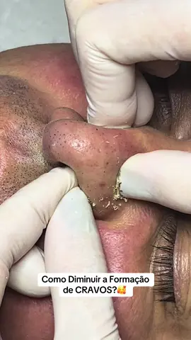 Limpeza de Pele ❤️ #estetica #viral #viraltiktok #beleza #rejuvenescimento #skincare #skincaretips #skins #limpezadepele #milium #cravoseespinhas #cravonaboca #comedaoaberto #acnefighter #acneskincare #cuidadoscomapele #cravosnonariz #cravononariz 