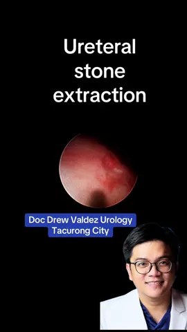 Ureteral stone extraction #docdrew #tacurong #urologist