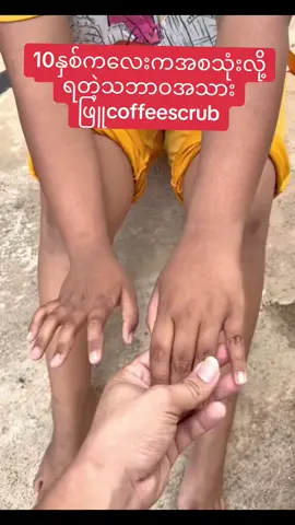 #အသားဖြူချင်သူများအတွက် #အမာရွတ်ပျောက်ချင်သူများအတွက်သာ #အမာရွက်အမဲစက်ပျောက်တယ် #ခြင်ကိုက်အမာရွတ်ပျောက်ချင်သူများ👀👀👀 #မဖြူရင်ငွေပြန်အမ်းမယ်🔥 #ကြည်လင်တောက်ပတဲ့အသားအရေကိုရဖို့ #scrubs #tulips #coffeescrub #may #maythazinoo #maytulipcoffeescrub #founder #ပြည်တွင်းဖြစ်ကိုအားပေးပါ🇲🇲🇲🇲 #fyp #fypシ 