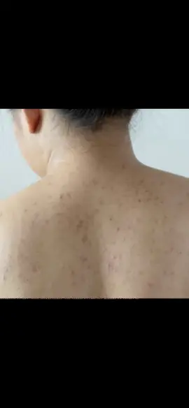 Clearing up my skin, one wash at a time!#ethiopian_tik_tok #ethiopian_tik_tok🇪🇹🇪🇹🇪🇹🇪🇹 #fyp #fy #beauty #shopping #dcbeautyshopsupply #skincare #habeshatiktok #skincare #panoxyl 