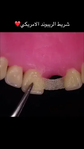 #شريط_الريبوند_الامريكي #dentis_dina_alqaisy #compositbridge #iraq_dental_ribbond #singlevisitbridge #dental_ribbond #compositbridge #erbil_dental_ribbond #erbil_dental_ribbond #Dr_Dina_alqaisy 