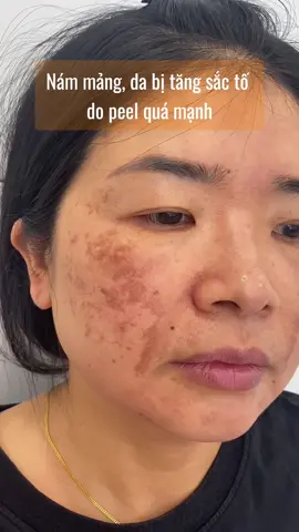 Chị em bị nám tàn nhang cần tìm hiểu kỹ trước khi làm để tránh bị tăng sắc tố như chị khách nhà em nhé. Sắp Tết rồi, t.rị nám ngay thôi ạ 😍 #hangtrinam #trinam #namnoitiet #namtannhang #kemnam #trinamda 