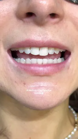 In this case I used composite edge bonding on 8 upper teeth to create more even lengths of the teeth & produce a more visible smile as in particular the upper back teeth were hidden 🤍