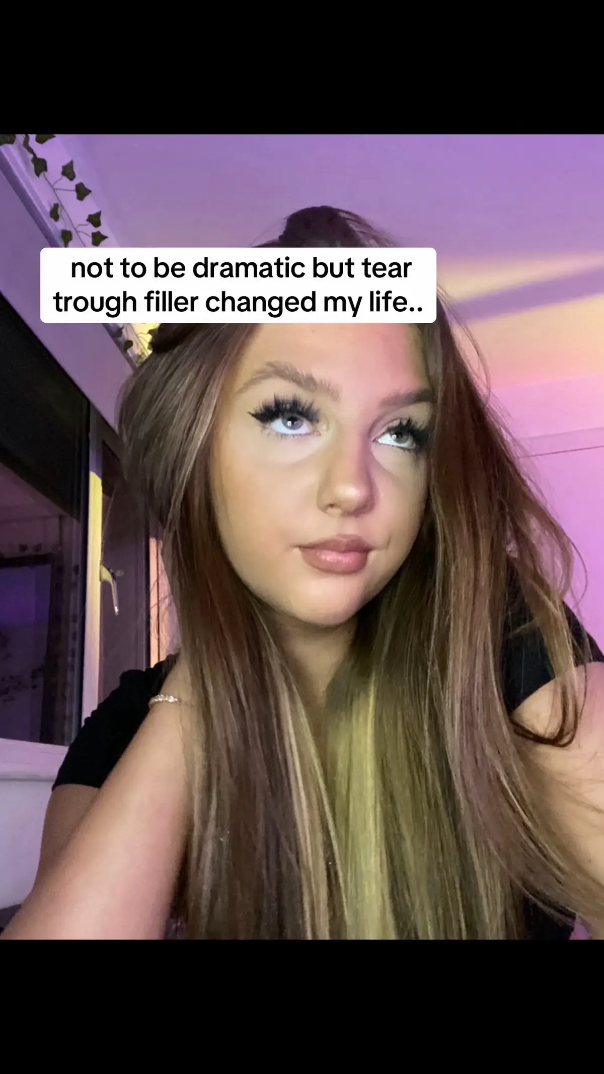 Tear trough/Under eye filler can be so transformative🙌🏻 If you want bright under eyes and to look more awake, this treatment could be for you 👀 If you have any questions about this treatment please drop us a DM and we will be happy to answer📩 #undereye #teartroughfillerleeds #brightundereye #leeds #filler #aesthetics #ministryoffaces