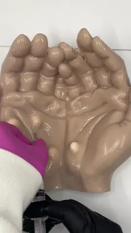 Hand cyst removal Relaxing  #asmrsounds #asmr #viral #fypシ #relax #skincare #mouthsounds #satisfying #tingles #asmrtriggers #mochipimplepopping #pimplepoppin #acnetreatment #asmrtiktoks  #hands #handcare #handtreatment 