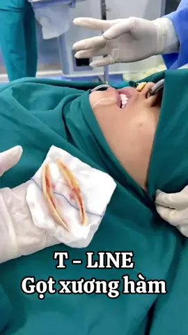 Gọt hàm v line cho bé khách yêu….🥰🥰🥰#nângmũiphongthuỷ #xuhuongtiktok #thâmmyantoan #Thẩmmytline #Thẩmmyt 
