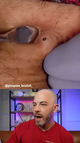 Dermatologist reacts to debris filled cyst! #pimplepop #cystpop #dermreacts #doctorreacts - #squeezeyuk #acne #pimple #pimplepop #blackhead #satisfying #foryoupage #foryou  #تنظيف_بشره  #whiteheads #رؤوس_سوداء #عنايه_بالبشره #دهون 