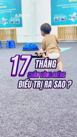 Trẻ 17 tháng tuổi chân vòng kiềng nên điều trị như thế nào??? #drde #ASINA #chanvongkieng #banchan #embe #xuhuong 