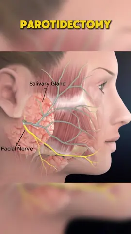 Parotidectomy  #medical #medical3danimation #medical3d #parotidectomy #parotidectomia #parotidectomynext #parotidectomysurgery #parotidectomiatotal 