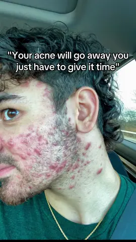 does anyone have acne or acne scars and knows how to help get rid of acne 😭 #acnescars #acnejourney #acne #acnetreatment #acneproneskin #accutane #accutanejourney #clearskin #sensitiveskin #skincare #acnetips #acneskincare 