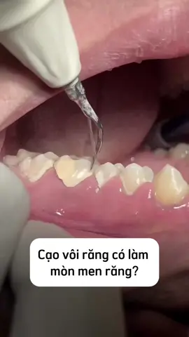 Cạo vôi răng làm mòn men răng, hỏng răng? #nhakhoa #nhakhoavananh #hoimieng #laycaorang #xuhuong #hanoi #fypシ゚ 