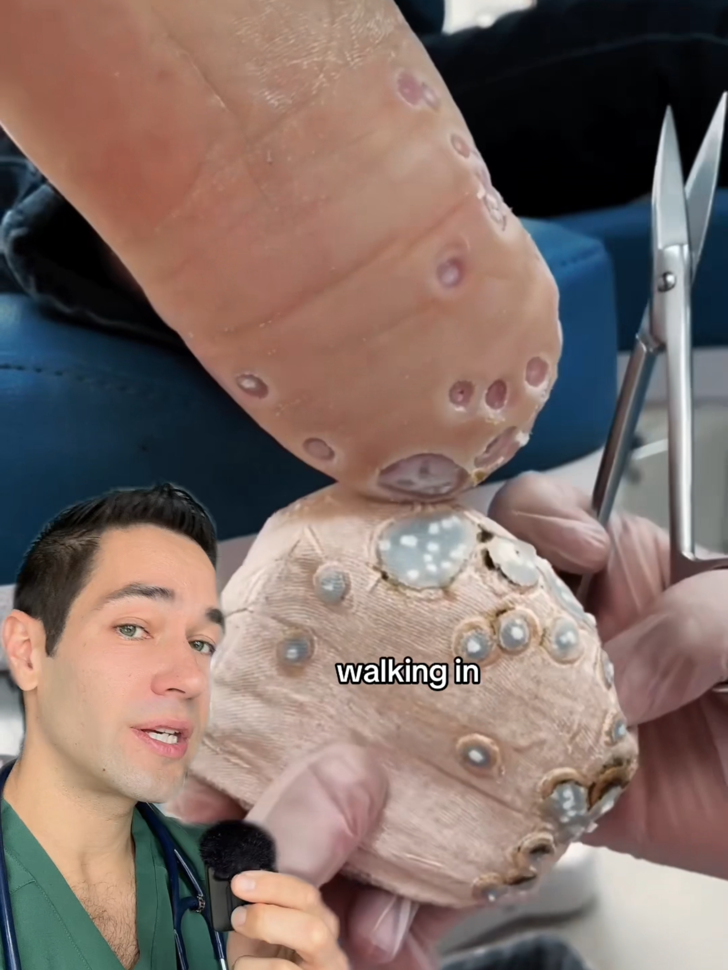 This is why you should always wear flip flops in public pools/showers! #warts #hpv #foothealth #hpvwarts #health