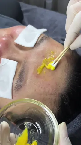 📌LIGHTENING CREAM - PEEL A HẠNG A Hoạt chất vitamin A 5% tái tạo đồng đều màu da, điều trị mụn tắc nghẽn, mụn đầu đen, thâm sau mụn.  Lightening A - Sản phẩm peel sở hữu nồng độ cao nhất của Retinol trên thị trường hiện nay. Kết cấu dạng cream đậm đặc giúp giảm tối thiểu các phản ứng phụ có thể xảy ra trong quá trình peel da.  SẢN PHẨM ĐẾN TỪ TÂY BAN NHA  👉Chỉ định da: Làn da có nhiều mụn cám, mụn ẩn, mụn đầu đen, làn da xỉn màu, điều trị sắc tố mức độ I và II ..  BẢNG THÀNH PHẦN SIÊU ĐỈNH:  5% Retinol  10% Lactic Acid  10% Salicylic Acid  5% Kojic Acid  5% Arbutin  1% Phytic Acid  #peelda #chamsocdakhoahoc #lighteningcream 