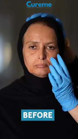 Discover our comprehensive range of anti-aging treatments: Face Rejuvenation: - Botox - Fillers (Hyaluronic Acid, Calcium Hydroxylapatite) - Chemical Peels - Microneedling Skin Tightening: - Radiofrequency (RF) Therapy - Laser Skin Tightening - HIFU (High-Intensity Focused Ultrasound) - Ultherapy Non-Surgical Facelift: - Thread Lift - Liquid Facelift (Combination of Fillers and Botox) Other Treatments: - PRP (Platelet-Rich Plasma) Therapy - PDRN (Polydeoxyribonucleotide) Therapy - Mesotherapy Benefits: - Minimal downtime - Long-lasting results - Customized treatment plans - Expert dermatologists Book Now! Call/WhatsApp: #03073730707 Address: Ali Towers, MM Alam Road Gulberg 3, Lahore #AntiAging #FaceRejuvenation #SkinTightening #NonSurgicalFacelift #Botox #Fillers #HIFU #Threads #PRP #PDRN #Mesotherapy #Dermatology #SkinCare #Beauty #Lahore #Pakistan #cureme #cmc #curememedicalcomplex 