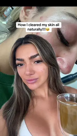 How i cleared my skin up with natural remedies and herbal outsourcing 🥹🥹‼️‼️  #healthtips #vitamins #heathylifestyle #skincare #guthealth #soursop #seamoss #ashwagandha #blackseedoil #Fitness #guthealthmatters #clearskin #acne #skinstok #gutcleanseforguthealth 