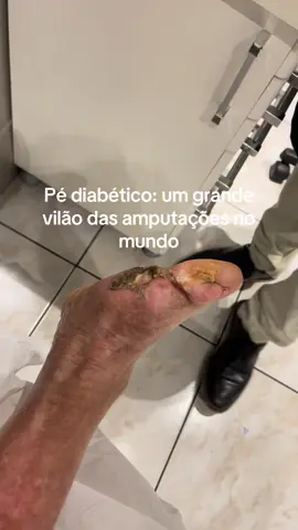 Você sabia que a cada quatro minutos uma pessoa é amputada no Brasil? Um dado triste que revela que temos muito a fazer ainda para prevenir e tratar as complicações nos pés de diabéticos 