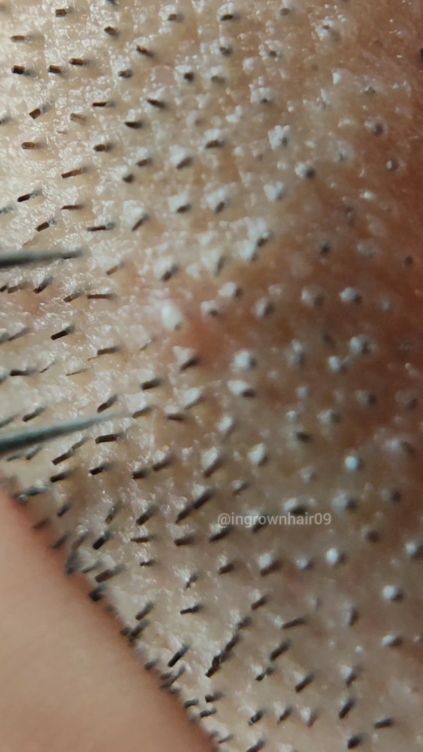 ASMR extractions ✨ #skinpicking #plucking #hairpulling #trichotillomania #ingrownhairremoval #tweezers #asmr #relax #extractions 