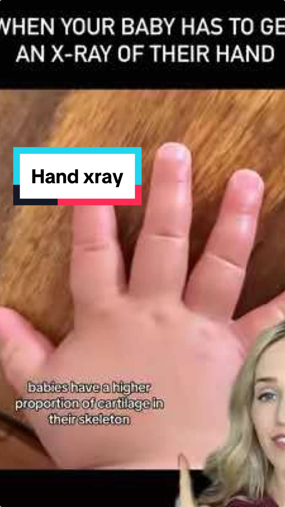 Why baby hand xrays look so different! #xray #baby #medical #doctor