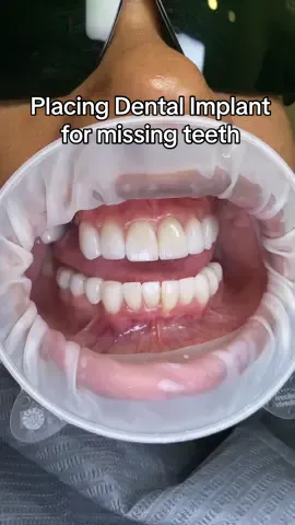 Placing dental implant for missing teeth 🦷 #dentalimplants #implants #dentalveneers #veneers #teethimplants #missingteeth 