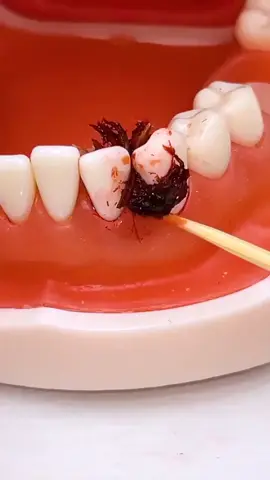 Part 75 | #foryou #foryoupage❤️❤️ #foryoupageofficiall #dentist #🦷 