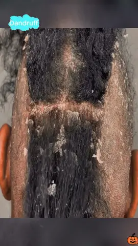 #dandruff #dandruffscratching #dandruffremoval #dandruffremovel #capcut #asmrvideo #fypage #satisfyingvideos #psoriasis #capcutedit