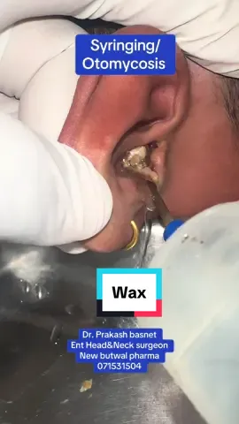 #otomycosis #syringing #wax #foryou #viral #trending #fyp #fypシ゚viral #entdoctorbutwal #ent 