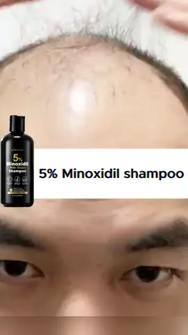 From Thin to Thick: The Power of Minoxidil Shampoo! #Minoxidil  #shampoo #HairCare #hairloss