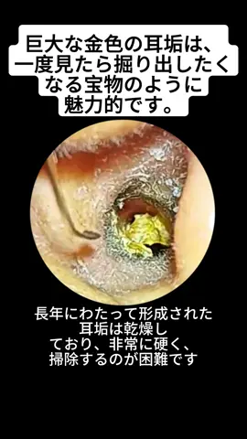 #earwaxcleaning #earwax #earcleaning #earwaxremoval #asmr #satisfyingvideo #satisfying 