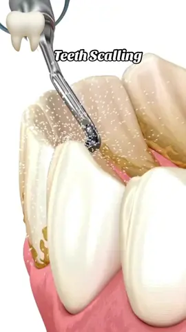 Part 85 | #foryou #foryoupage❤️❤️ #foryoupageofficiall #🦷 #foryoupageofficiall #teethwhitening #teethscaling 