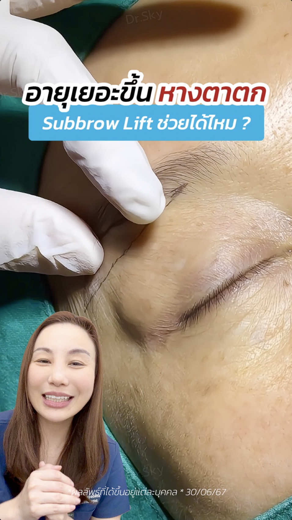 อายุเยอะขึ้น #หางตาตก หนังตาเยอะ ‼️ #subbrowlift #ซ่อนแผลใต้คิ้ว #หมอสกาย #จักษุแพทย์ #ซ่อนไหมไร้รอยเข็ม #หมอตา #สกายคลินิก #ทำตาที่ไหนดี #skyclinic #ทำตาสองชั้น #รีวิวตาสองชั้น 