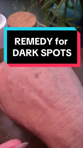 I’m quite impressed by the effectiveness of REMEDY for DARK SPOTS. IT IS HELPING WITH MY DARK SPOTS AND SKIN DISCOLORATION, AND ONLY AFTER TWO WEEKS OF USE! #darkspottreatment #darkspotremoval #skindiscolouration #ConSantanderConecto 