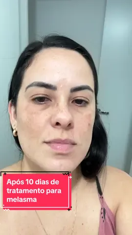 Novo tratamento para melasma. Resultado após 10 dias de tratamento. #melasma #tratamentomelasma #cuidadoscomapele #melab3 #viral #fyp #foryou 