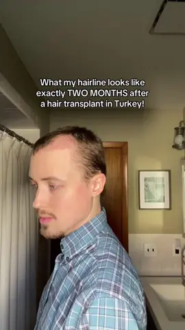 what my hairline looks like exactly two months after my hair transplant in turkey! i cant believe its already been that long 🤯 #hairtransplant #turkeyhairtransplant #menshair #hairtransformation  hair transplant by: @Haircenterofturkey  this video specifically is not sponsored, but i wanted to note that i received this procedure as a gifted collaboration with the hair center of turkey, as is noted in my previous paid partnership videos! all opinions are entirely my own. 