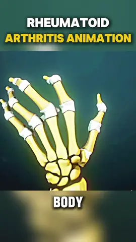 What Happens Inside Your Joints? 🤔 | Rheumatoid Arthritis Explained in 3D #RheumatoidArthritis #JointHealth #MedicalAnimation #ArthritisRelief #ChronicPain #AutoimmuneDisease #HealthEducation #3DAnimation #MedFlux3D #InjuryExplained