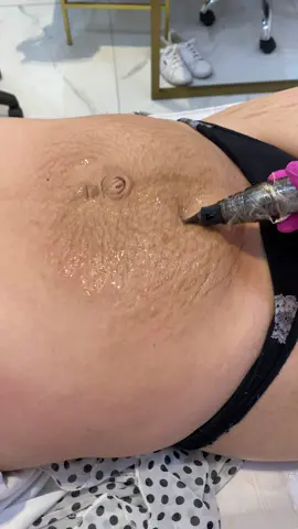 Método R.A.R ✨  Trata estria por estria, sem acidos ou pigmentos!  #metodorar #tratamentodeestrias #fyppppppppppppppppppppppp #fypシ #gorduralocalizada #esteticista #estriasbrancasnuncamais #estriasbrancas #estetica #metodoRAR #estriabranca #estriaposparto #tratandoestrias #estriasbrancasnuncamais #estriasbrancas 