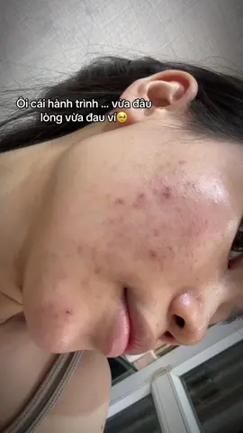 #CapCut Giờ chưa đẹp nhưng cũng đã có sự cố gắng . Mong mn sớm hết mụn trước Tết #TikTokAwardsVN #xh #thaydoibanthan #ngakhonggay #trịmụn 