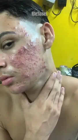 Salicylic Acid Anti-Acne Cleanser facial,Wash refreshing our face and reduce oil production and reduce ane!#facialwash #acneremoval #acne #acnetreatment #acneproneskin #antiacne #facialcleanser #salicylicacid