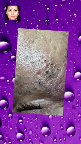 #pimple #pimplepop #acne #squeeze #skincare #blackhead#satisfying #foryou3