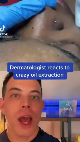 So much oil from this nose! - 208SkinDoc - #squeezeyuk #acne #pimple #pimplepop #blackhead #satisfying #foryoupage #foryou  #تنظيف_بشره  #whiteheads #رؤوس_سوداء #عنايه_بالبشره #دهون 